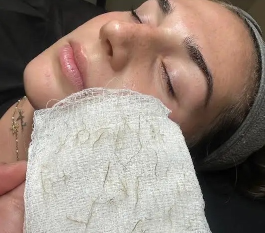 Dermaplaning at The Chateau Glo